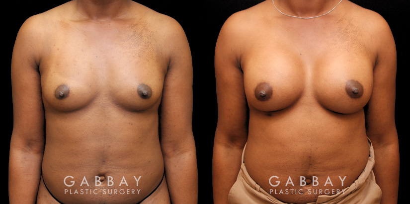 Patient before and after receiving silicone implants to increase breast roundness and overall volume. Results are shown following complete, smoother recovery.