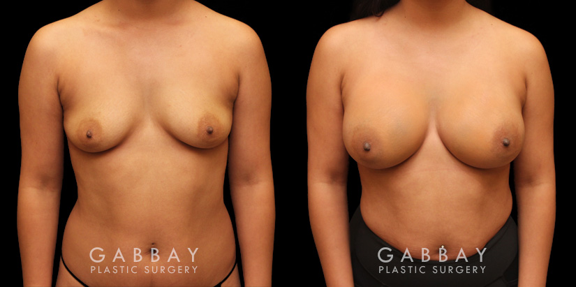 Photos for female patient before and after silicone implant procedure. Note the robust increase in breast size while continuing to match her body's aesthetic for an aligned appearance.