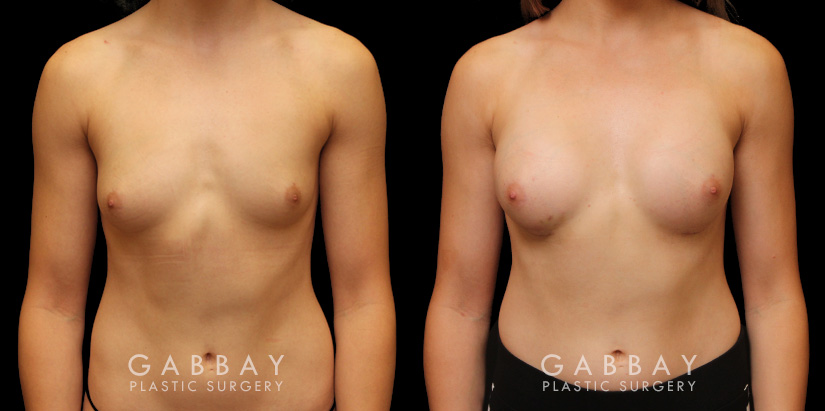 Patient wanted very mild breast augmentation to improve the roundness and curve of breasts. Results show increase from minimal breast shape to a gentle rounding slope to the breasts.