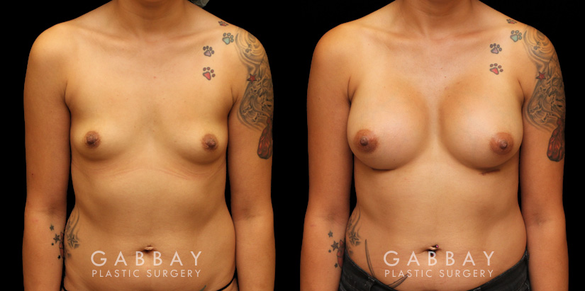 Silicone implants were used to increase breast roundness and volume. Note how the breasts kept their position while filling out for a balanced appearance.