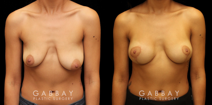 Breast lift combined with breast augmentation using silicone implants. Before-and-after photos demonstrate dramatic aesthetic enhancement of the breasts regarding shape, size, and position. Breast drooping was completely addressed and symmetry was enhanced.