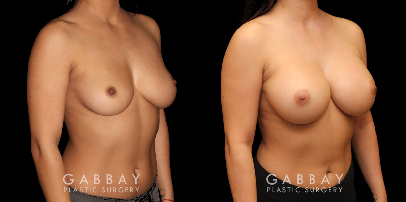 This is a breast augmentation patient who had significant asymmetry. She underwent silicone breast implant augmentation, using different sized high profile Allergan Natrelle Soft Touch implants: 365 cc on the left, 435 cc on the right. Implants were placed below the muscle in a dual plane configuration using an incision that is beautifully hidden within the breast fold.