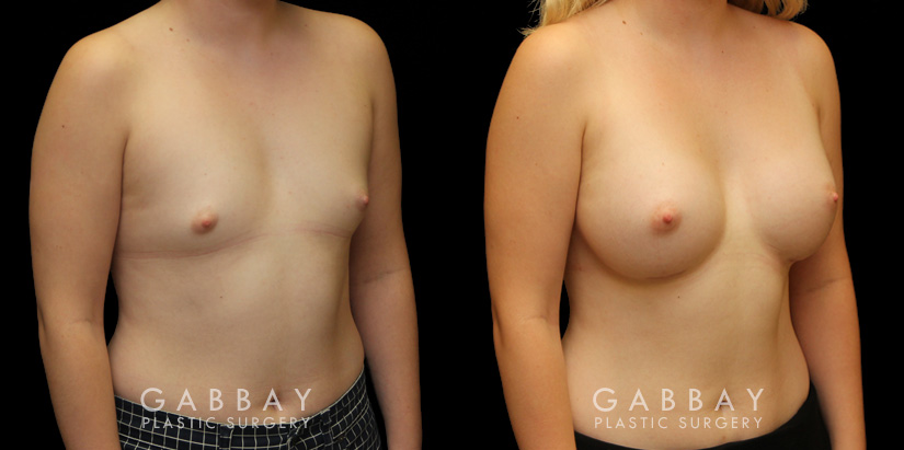 Patient results for breast augmentation with silicone implants. Before there was minimal breast volume, with the results increasing size without damaging the skin around the breasts. Note the lack of visible scarring.