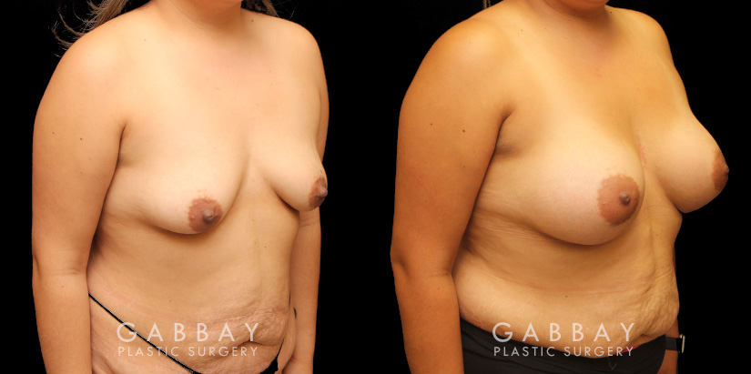 Silicone implant results. Patient increased breast size and used the implants to reduce breast drooping as well, without the need for mastopexy in addition.