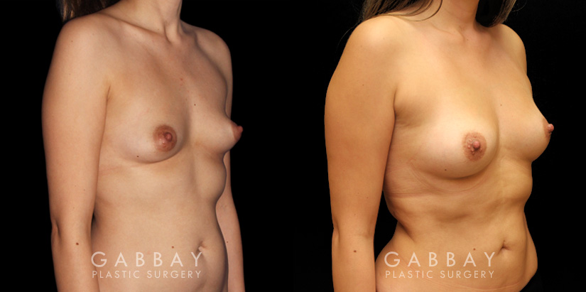 Patient 01 3/4th Right Side View Breast Fat Grafting Gabbay Plastic Surgery