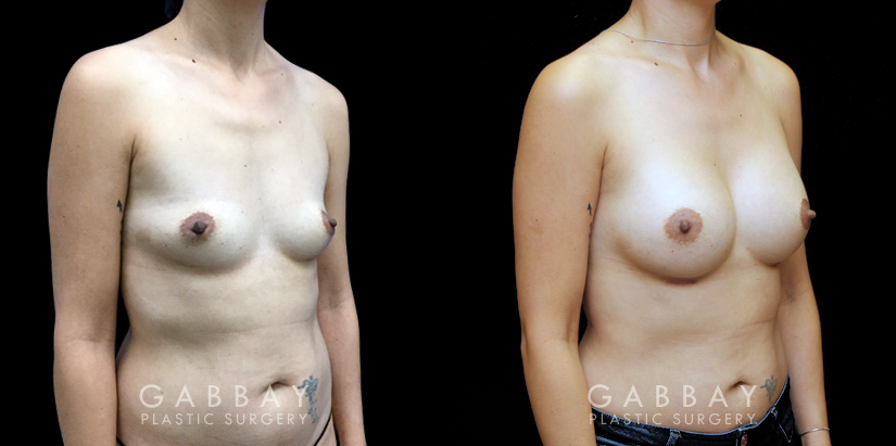 Breast Augmentation – Silicone