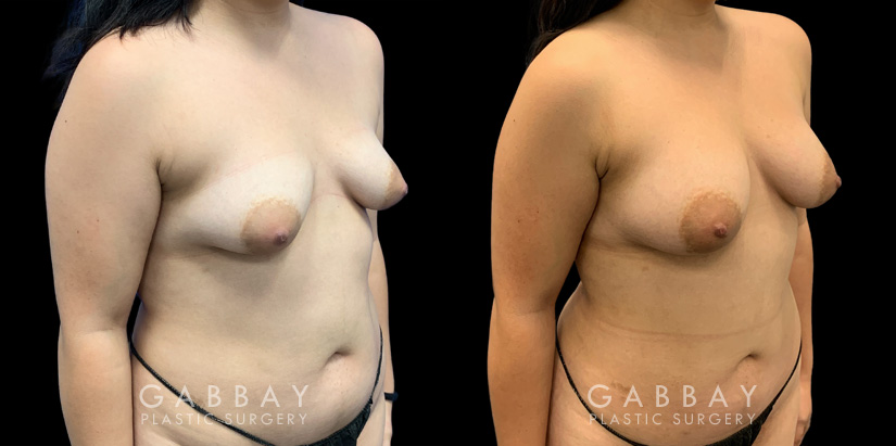 Patient 04 3/4th Right Side View Breast Fat Grafting Gabbay Plastic Surgery