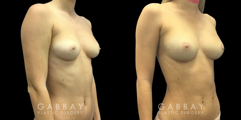 Patient 06 3/4th Right Side View Breast Fat Grafting Gabbay Plastic Surgery