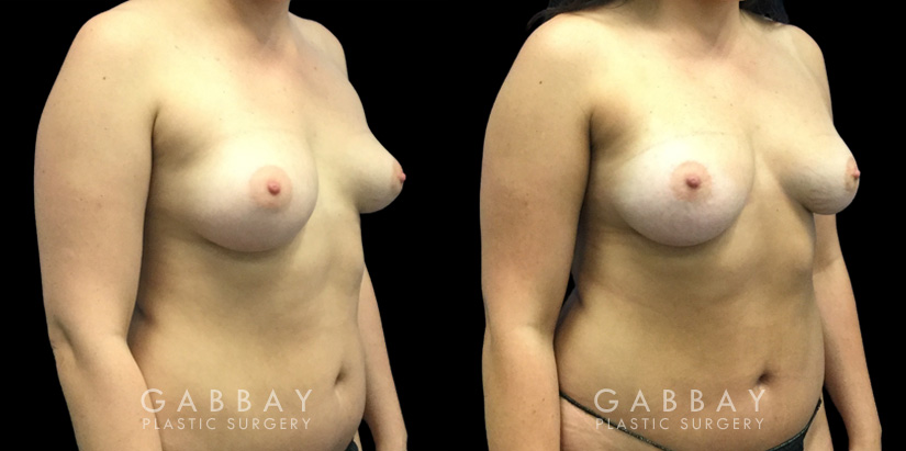 Patient 07 3/4th Right Side View Breast Fat Grafting Gabbay Plastic Surgery