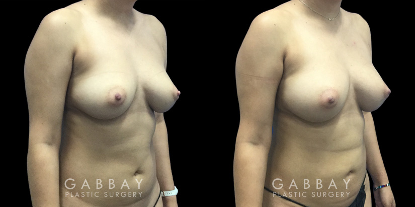 Patient 08 3/4th Right Side View Breast Fat Grafting Gabbay Plastic Surgery