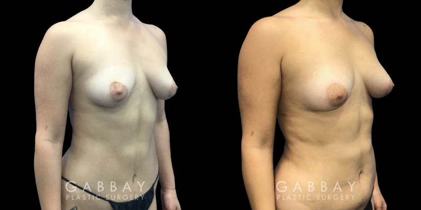 Patient 09 3/4th Right Side View Breast Fat Grafting Gabbay Plastic Surgery