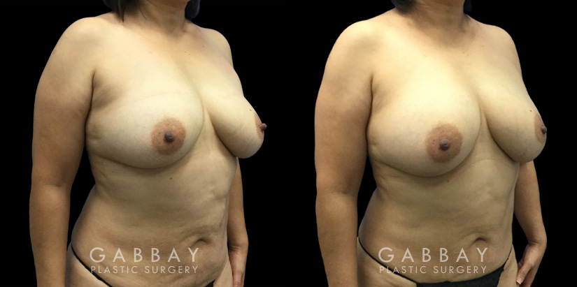 Patient 10 3/4th Right Side View Breast Fat Grafting Gabbay Plastic Surgery