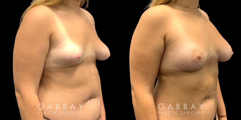 Patient 11 3/4th Right Side View Breast Fat Grafting Gabbay Plastic Surgery
