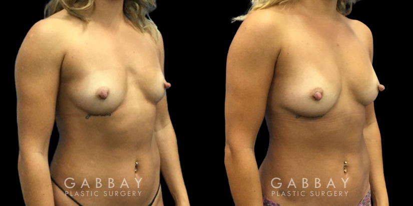 Patient 12 3/4th Right Side View Breast Fat Grafting Gabbay Plastic Surgery