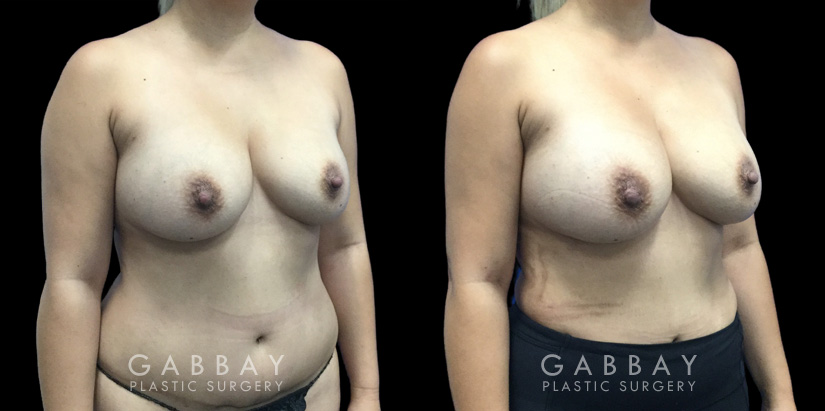 Patient 13 3/4th Right Side View Breast Fat Grafting Gabbay Plastic Surgery