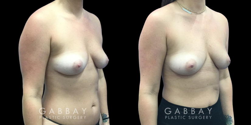 Patient 14 3/4th Right Side View Breast Fat Grafting Gabbay Plastic Surgery