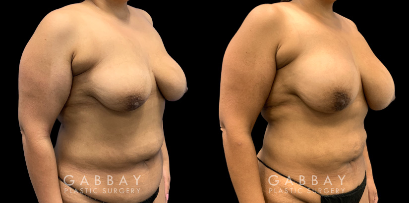 Patient 15 3/4th Right Side View Breast Fat Grafting Gabbay Plastic Surgery