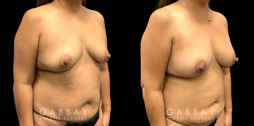 Patient 16 3/4th Right Side View Breast Fat Grafting Gabbay Plastic Surgery