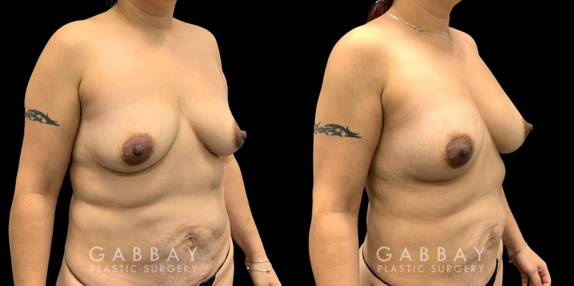 Patient 17 3/4th Right Side View Breast Fat Grafting Gabbay Plastic Surgery