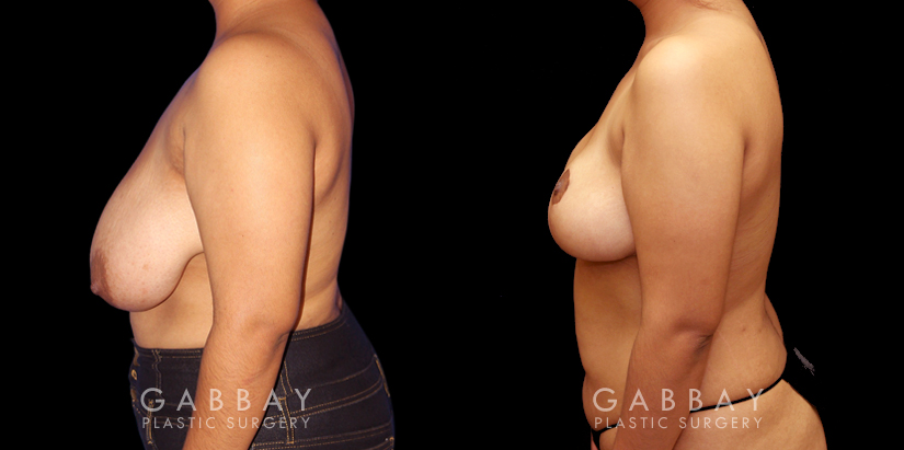 Patient 03 Left Side View Mastopexy Gabbay Plastic Surgery