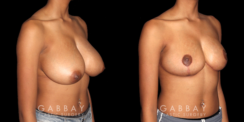 Patient 04 3/4th Right Side View Breast Reduction Gabbay Plastic Surgery