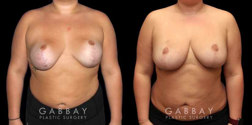 Patient 03 Front View Revision Breast Reduction, Revision Wide Mastopext, Belladerm Gabbay Plastic Surgery