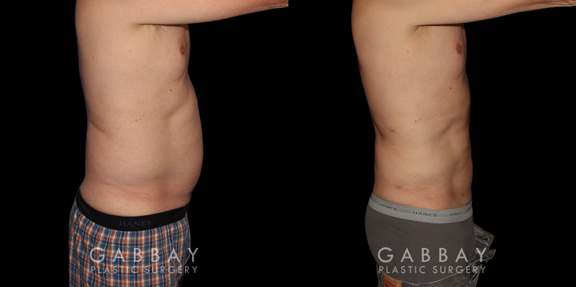 Male patients with liposuction results for full abdominal contouring. Patient healed well with minimal visible scarring and a flat stomach as seen in the profile view.