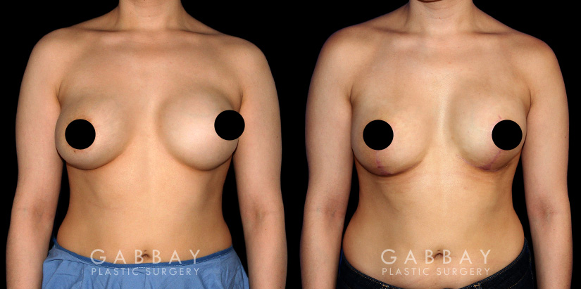 Patient 01 Front View Breast Revision Before and After Gabbay Plastic Surgery