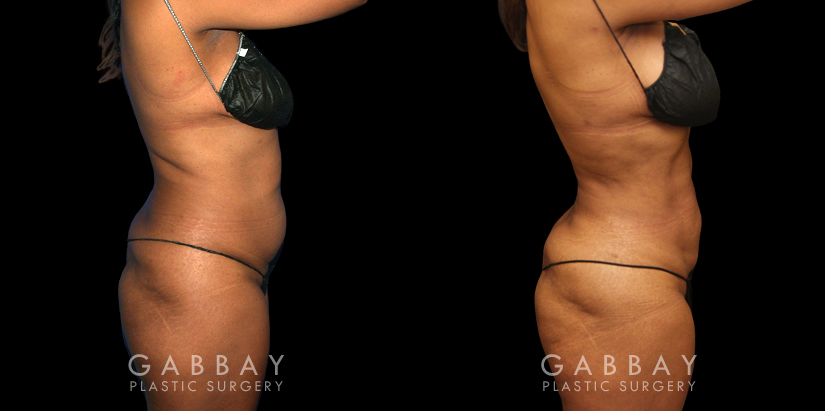 Female patient’s liposuction results, tightening her abdomen area significantly while minimizing any scarring. Patient recovered without complications and enjoyed an enhanced visibility of her natural curvy contours.
