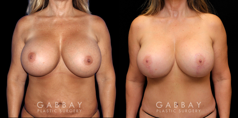 Patient 14 Front View Abdominoplasty Gabbay Plastic Surgery