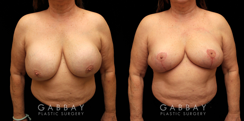 Patient 17 Front View Implant Removal and Lift Gabbay Plastic Surgery