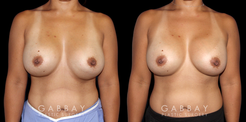 Patient 19 Front View Breast Revision Gabbay Plastic Surgery