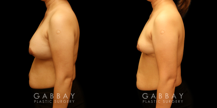 Patient 09 Left Side View Breast Implant Removal and Lift Gabbay Plastic Surgery