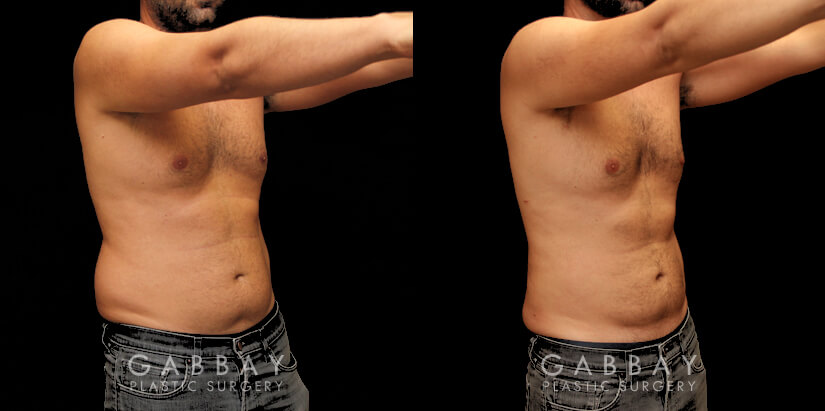 Patient 01 3/4th Right Side View Liposuction and J Plasma to Full Abdomen Gabbay Plastic Surgery