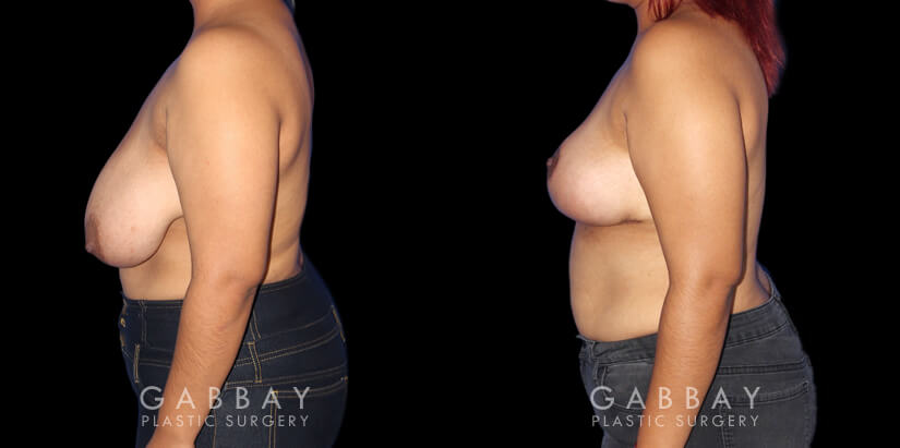 Patient 01 Left Side View Breast Mastopexy Gabbay Plastic Surgery