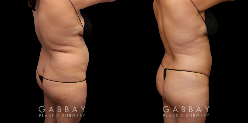 Liposuction Before & After Gallery: Patient 16