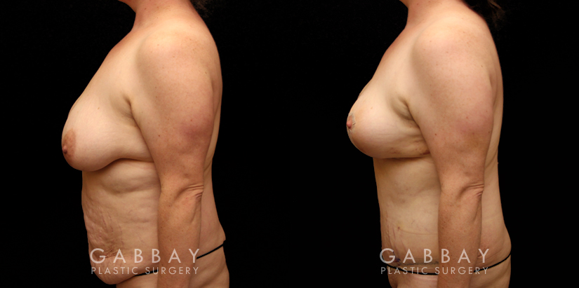 Patient 11 Left Side View Tummy Tuck and Breast Lift Gabbay Plastic Surgery