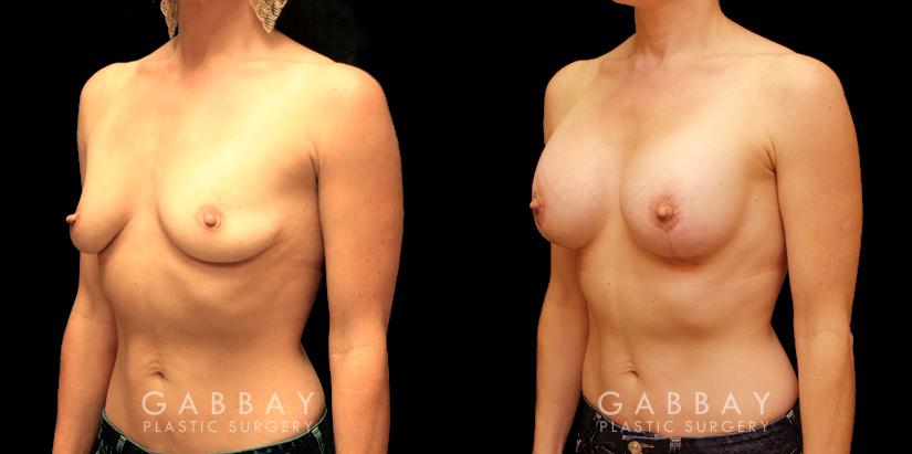 Patient 12 3/4th Left Side View Breast Augmentation with Areola Lift Gabbay Plastic Surgery