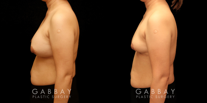 Patient 13 Left Side View Breast Implant Removal and Lift Gabbay Plastic Surgery