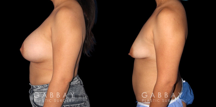 Patient 16 Left Side View Breast Augmentation Silicone & Lift Gabbay Plastic Surgery