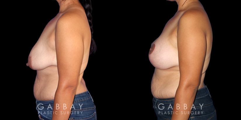 Patient 18 Left Side View Breast Augmentation Silicone, Mastopexy Gabbay Plastic Surgery