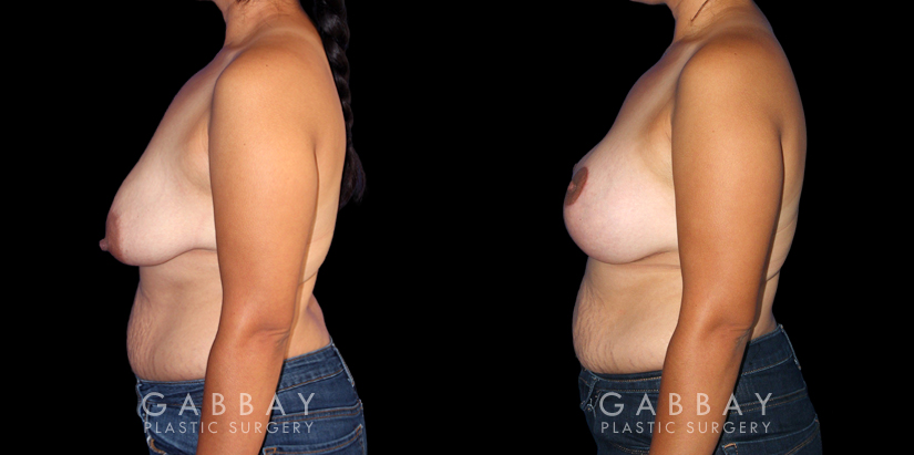 Breast Augmentation – Silicone, Mastopexy