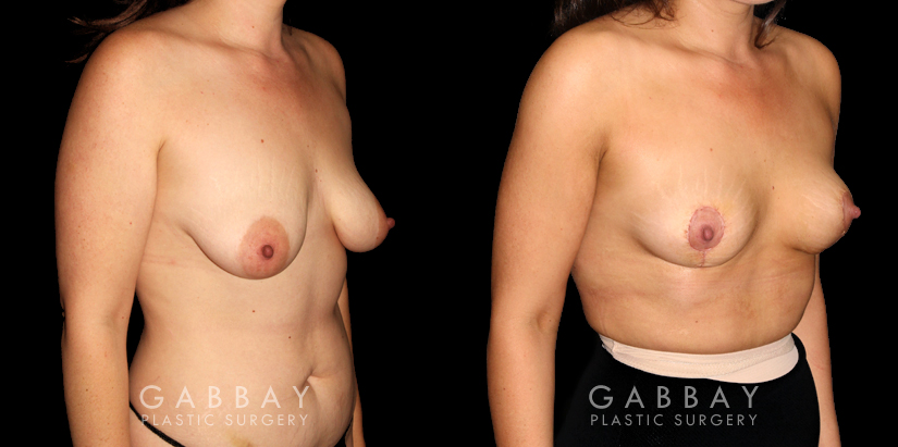 Patient 21 3/4th Right Side View Mastopexy and Liposuction Gabbay Plastic Surgery