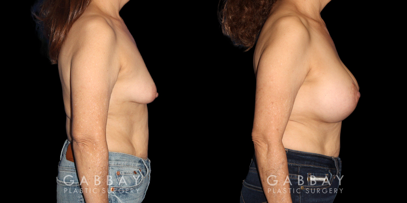 Patient 24 Right Side View Breast Augmentation W/Mastopexy Silicone Implants Gabbay Plastic Surgery