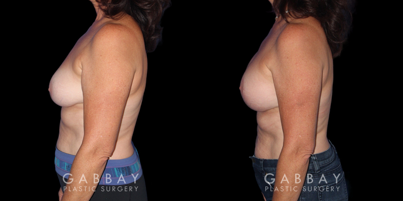 Patient 26 Left Side View R&R Breast Lift Gabbay Plastic Surgery