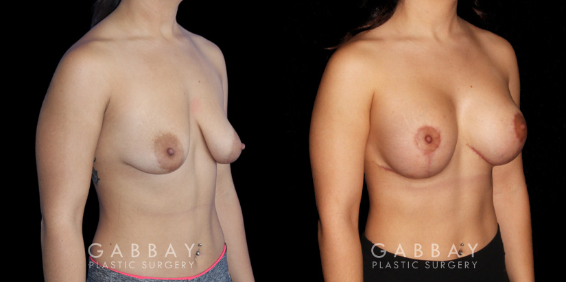 Breast Augmentation w/ Mastopexy – Silicone