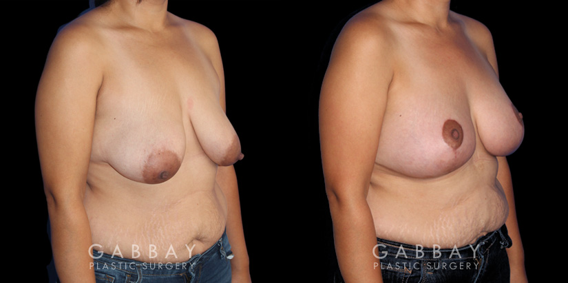 Breast Augmentation – Silicone, Mastopexy