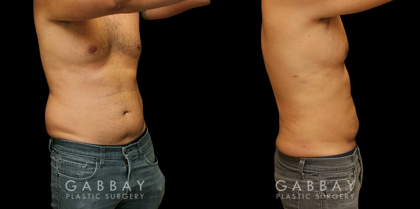 Male liposuction results after reducing stubborn belly fat that would not respond to diet or exercise. The belly area went from significant overhang above the beltline to a flatter contour.