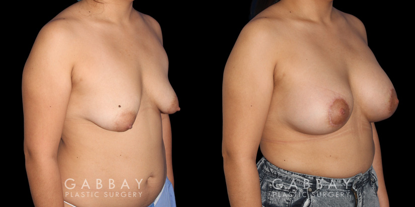 Patient 15 3/4th Right Side View Breast Augmentation - Silicone & Lift Gabbay Plastic Surgery