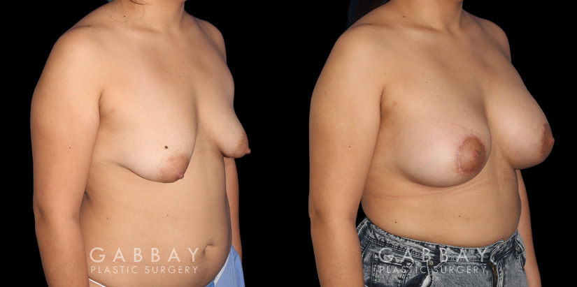 Breast Augmentation – Silicone & Lift